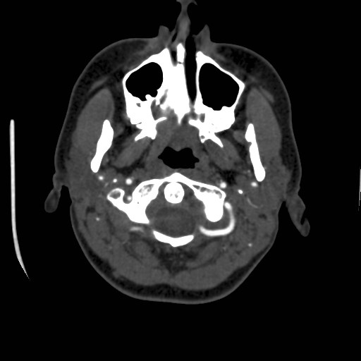Cerebral venous sinus thrombosis (Radiopaedia 40619-43227 A 7).jpg