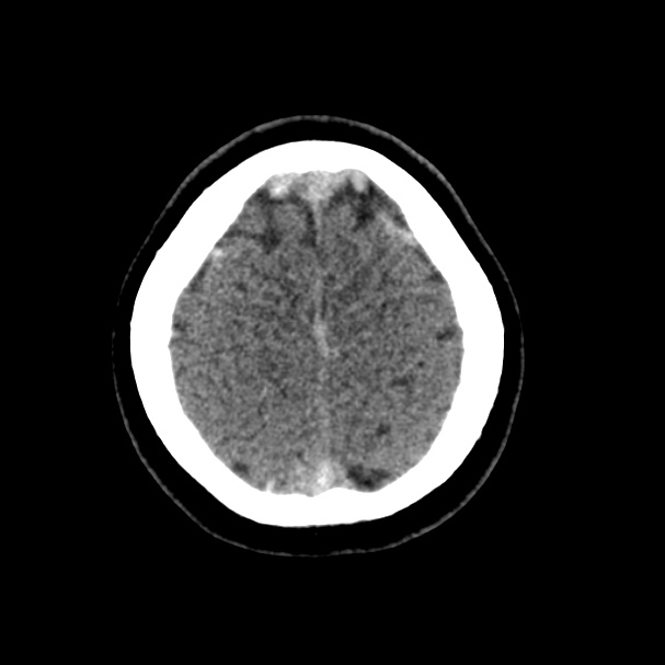 Cerebral venous sinus thrombosis (Radiopaedia 59224-66551 Axial non-contrast 45).jpg