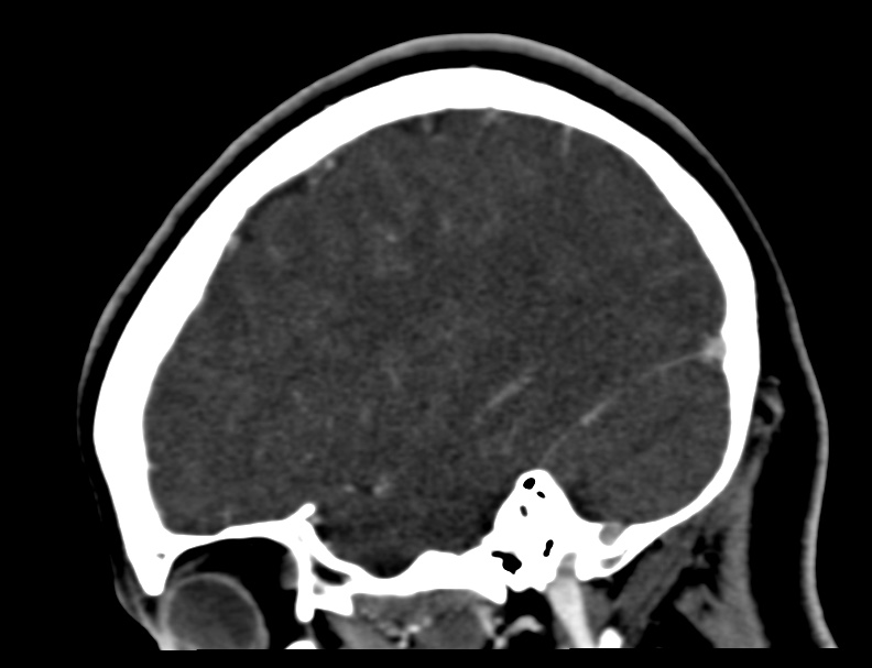 Cerebral venous sinus thrombosis (Radiopaedia 59224-66646 Sagittal C+ delayed 1).jpg