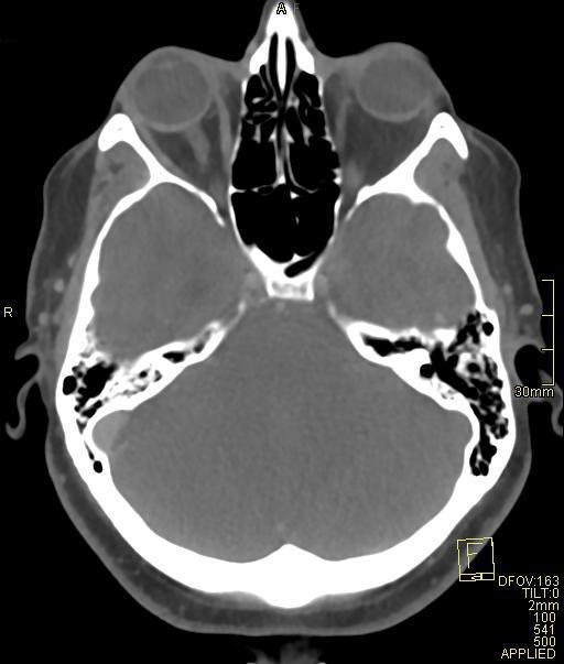 Cerebral venous sinus thrombosis (Radiopaedia 91329-108965 Axial venogram 26).jpg