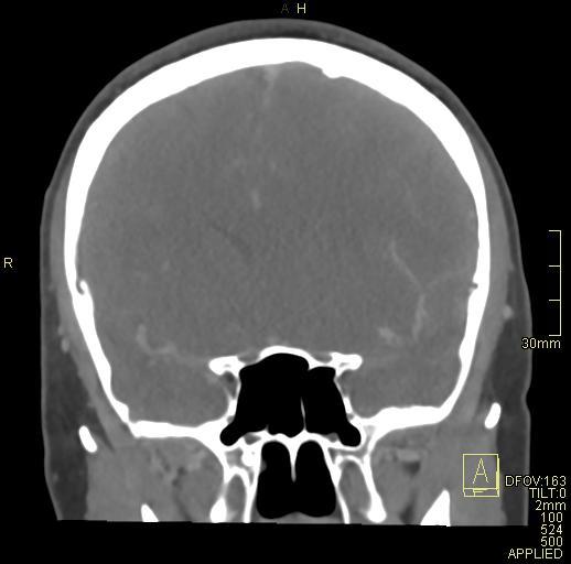 File:Cerebral venous sinus thrombosis (Radiopaedia 91329-108965 Coronal venogram 34).jpg
