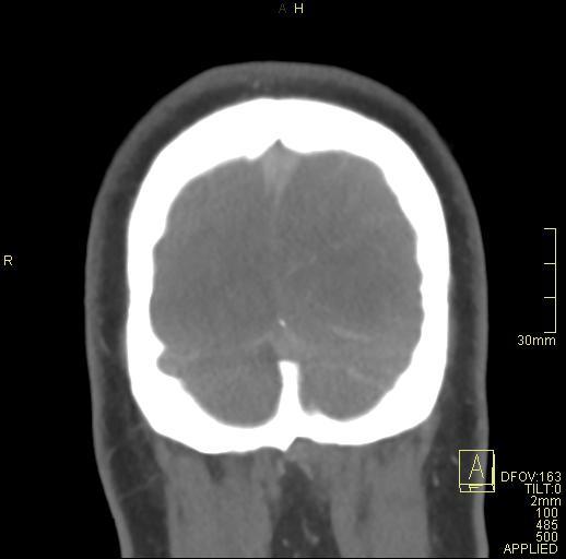 Cerebral venous sinus thrombosis (Radiopaedia 91329-108965 Coronal venogram 80).jpg