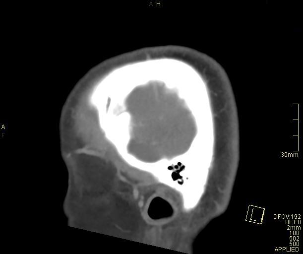 Cerebral venous sinus thrombosis (Radiopaedia 91329-108965 Sagittal venogram 8).jpg
