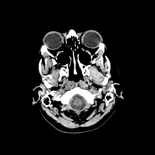 Cerebral venous throbmosis - hemorrhagic venous infarction (Radiopaedia 87318-103613 Axial non-contrast 13).jpg
