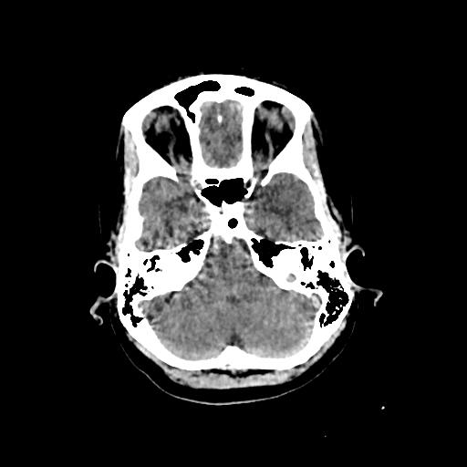 File:Cerebral venous throbmosis - hemorrhagic venous infarction (Radiopaedia 87318-103613 Axial non-contrast 36).jpg