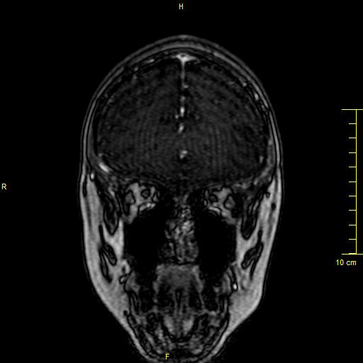 Cerebral venous thrombosis (Radiopaedia 23288-23351 MRV 17).JPG