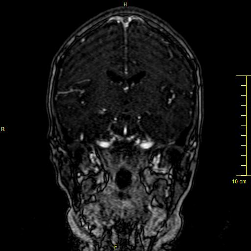 Cerebral venous thrombosis (Radiopaedia 23288-23351 MRV 73).JPG