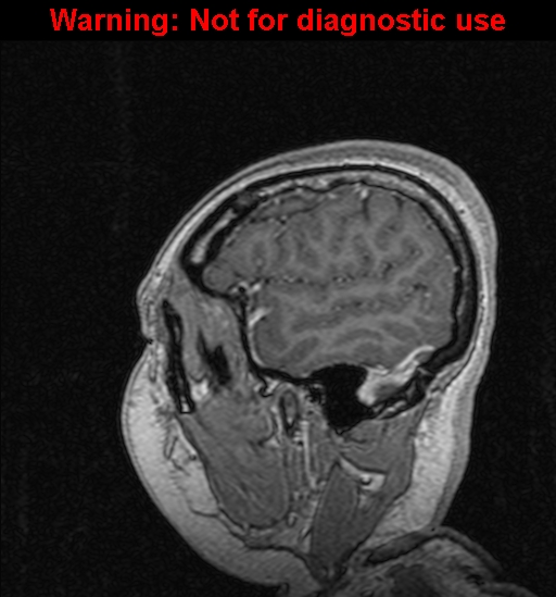 Cerebral venous thrombosis (Radiopaedia 37224-39208 Sagittal T1 C+ 25).jpg