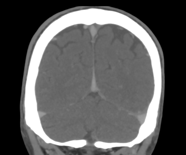 Cerebral venous thrombosis (Radiopaedia 38392-40467 Coronal CTA-Venogram 50).png