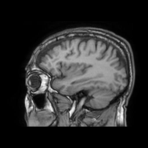 File:Cerebral venous thrombosis with secondary intracranial hypertension (Radiopaedia 89842-106957 Sagittal T1 9).jpg