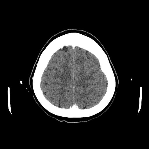 File:Cerebral venous thrombosis with venous hemorrhagic infarct (Radiopaedia 90354-107660 Axial with contrast 136).jpg