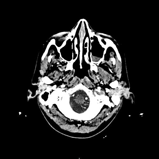 Cerebral venous thrombosis with venous hemorrhagic infarct (Radiopaedia 90354-107660 Axial with contrast 19).jpg