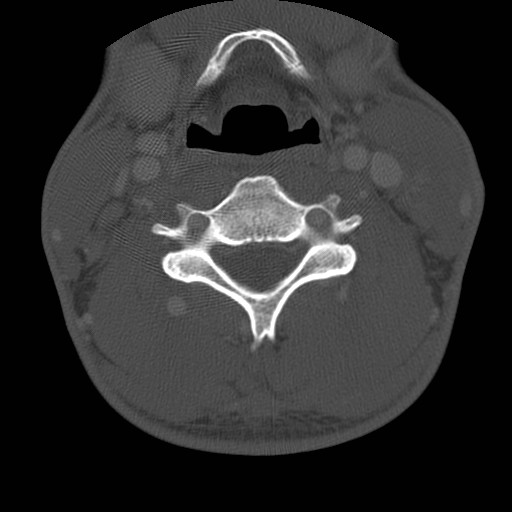 Cervical Pott disease (Radiopaedia 20374-20286 Axial bone window 84).jpg