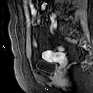 File:Cervical adenocarcinoma (Radiopaedia 65011-73985 E 8).jpg