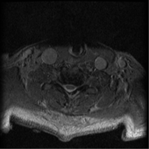 Cervical canal stenosis with cord compression (Radiopaedia 34114-35374 Axial Gradient Echo 23).png