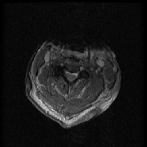 Cervical canal stenosis with cord compression (Radiopaedia 34114-35374 Axial Gradient Echo 57).png