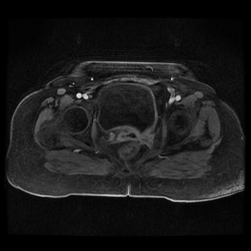 Cervical carcinoma (Radiopaedia 70924-81132 Axial T1 C+ fat sat 218).jpg