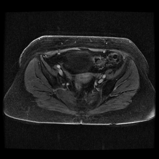 File:Cervical carcinoma (Radiopaedia 70924-81132 Axial T1 C+ fat sat 61).jpg