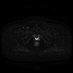 Cervical carcinoma (Radiopaedia 85405-101028 Axial DWI 22).jpg