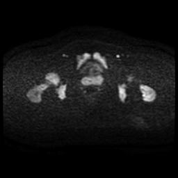 Cervical carcinoma (Radiopaedia 88010-104555 Axial DWI 64).jpg