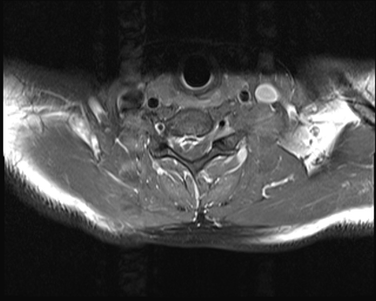 File:Cervical disc extrusion (Radiopaedia 53950-60077 Axial T1 C+ fat sat 19).jpg