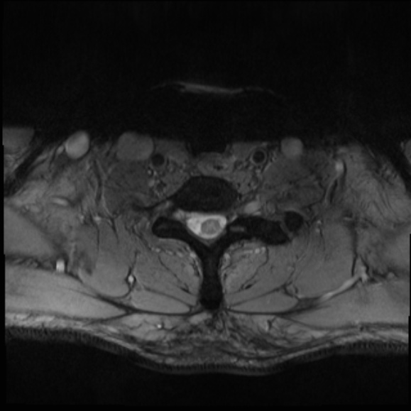 File:Cervical disc extrusion (Radiopaedia 53950-60077 Axial T2 29).jpg