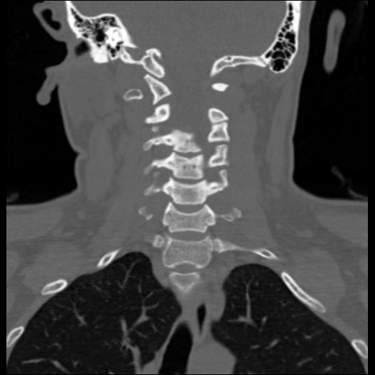 File:Cervical rib (Radiopaedia 71110-81363 Coronal non-contrast 25).jpg