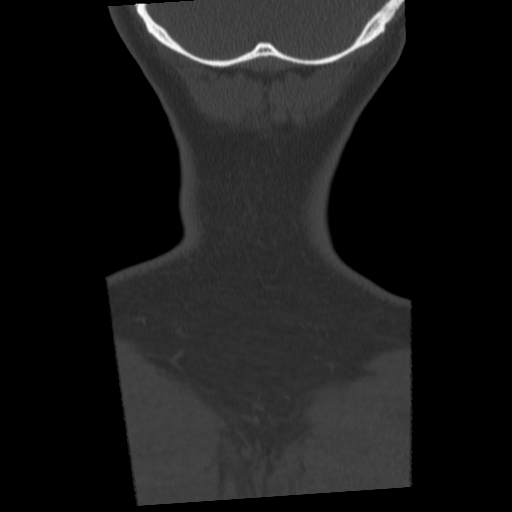 Cervical schwannoma (Radiopaedia 57979-64974 Coronal bone window 58).png