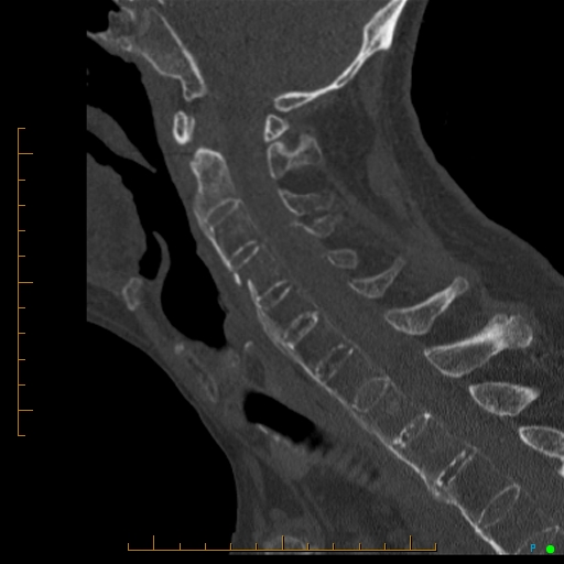 Cervical spine fracture - ankylosing spondylitis (Radiopaedia 76835-88706 Sagittal bone window 55).jpg