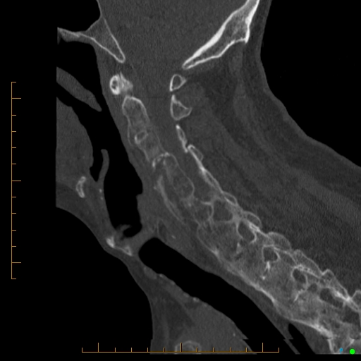 File:Cervical spine fracture - ankylosing spondylitis (Radiopaedia 76835-88706 Sagittal bone window 67).jpg