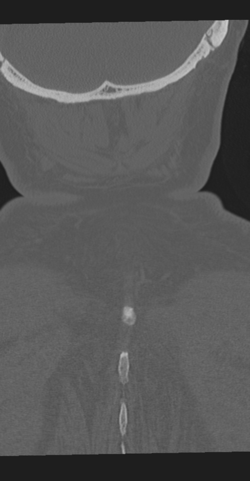 Cervical spine fracture in the setting of ankylosis (Radiopaedia 37038-38715 Coronal bone window 70).png