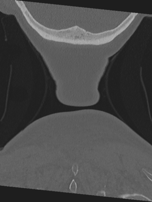 Cervical spondylolysis (Radiopaedia 49616-54811 Coronal bone window 69).png