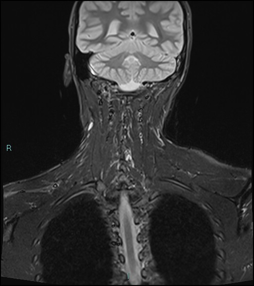 File:Cervical thymic cyst (Radiopaedia 88632-105336 Coronal STIR 31).jpg