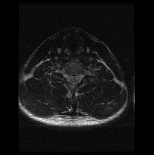 File:Cervical vertebrae metastasis (Radiopaedia 78814-91667 Axial T2 5).png