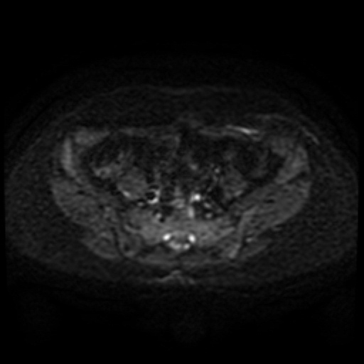 File:Cesarian section scar endometriosis (Radiopaedia 66520-75799 Axial DWI 29).jpg