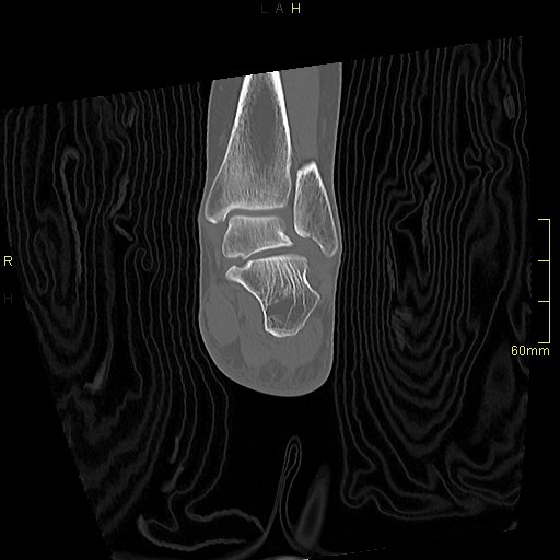 Chaput tubercle fracture (Radiopaedia 80319-93956 Coronal non-contrast 43).jpg