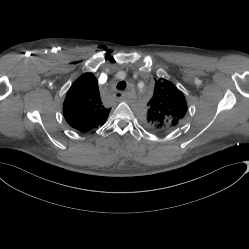 File:Chest multitrauma - aortic injury (Radiopaedia 34708-36147 A 62).png