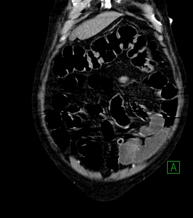 Cholangiocarcinoma with cerebral metastases (Radiopaedia 83519-98629 E 18).jpg