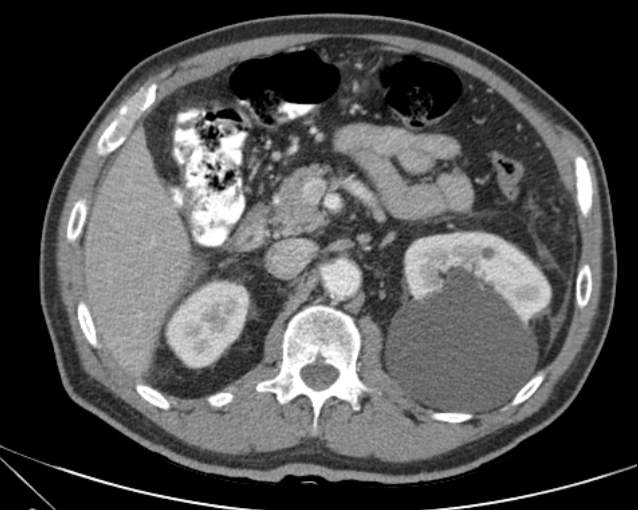 Cholecystitis - perforated gallbladder (Radiopaedia 57038-63916 A 33).jpg