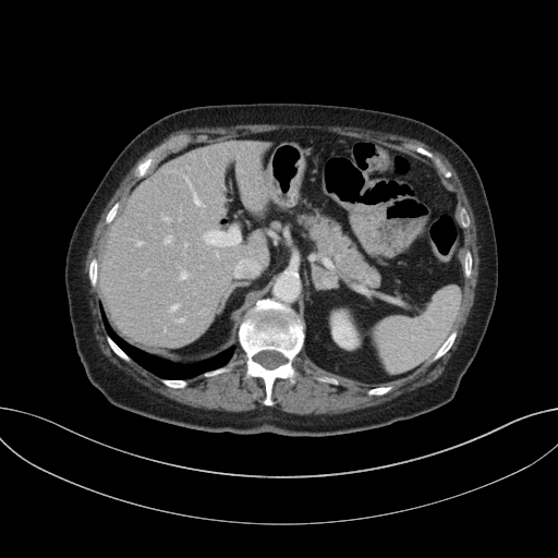 Cholecystoduodenal fistula due to calculous cholecystitis with gallstone migration (Radiopaedia 86875-103077 D 26).jpg