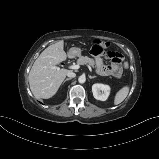 Cholecystoduodenal fistula due to calculous cholecystitis with gallstone migration (Radiopaedia 86875-103077 D 29).jpg