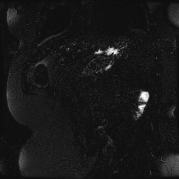 Choledocholithiasis on CT and MRI (Radiopaedia 24825-25088 Coronal T2 95).jpg