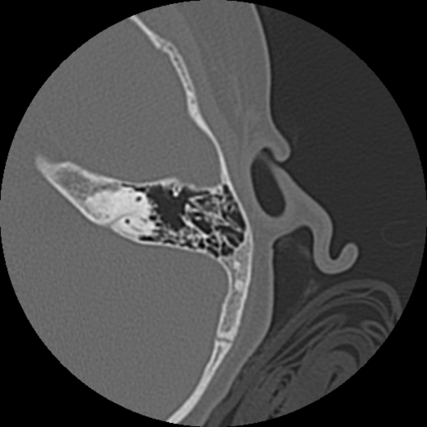 Cholesteatoma (Radiopaedia 73023-83750 Axial Left ear 58).jpg