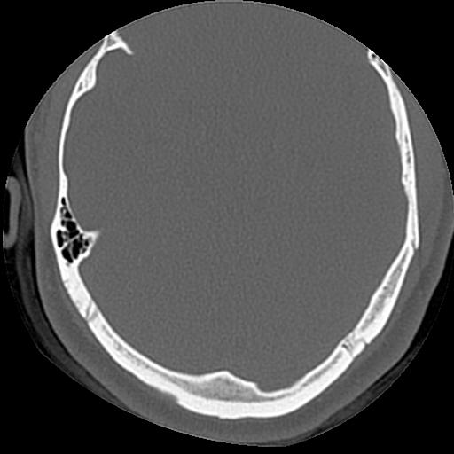 File:Cholesteatoma (Radiopaedia 84960-100474 Axial bone window 20).jpg
