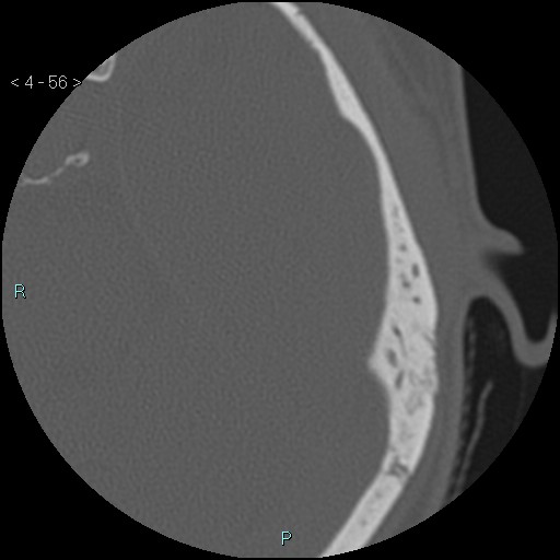 File:Cholesterol granuloma of the petrous apex (Radiopaedia 64358-73141 Axial bone window 27).jpg