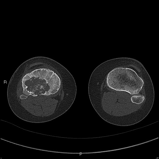 Chondroblastoma (Radiopaedia 62721-71030 Axial bone window 59).jpg
