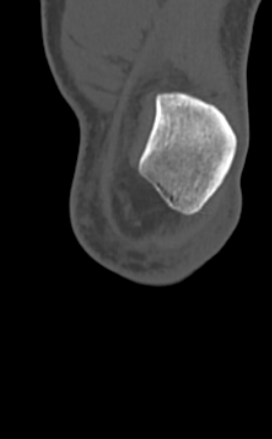 Chondrocalcinosis (Radiopaedia 82862-97173 Coronal bone window 11).jpg
