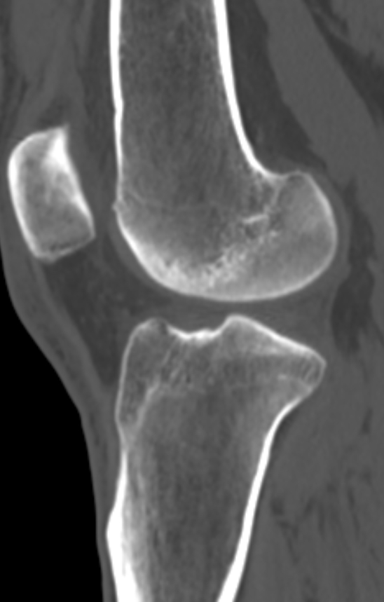 Chondrocalcinosis (Radiopaedia 82862-97173 Sagittal bone window 38).jpg