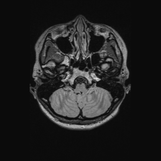 Chondrosarcoma (Radiopaedia 41937-44939 Axial FLAIR 27).png