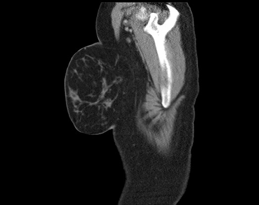 Chondrosarcoma - chest wall (Radiopaedia 65192-74199 B 4).jpg